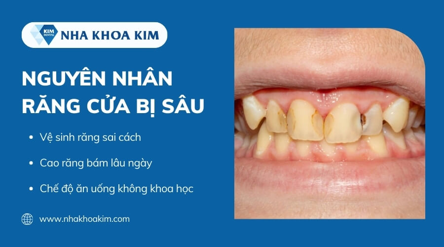 Nguyên nhân sâu răng cửa