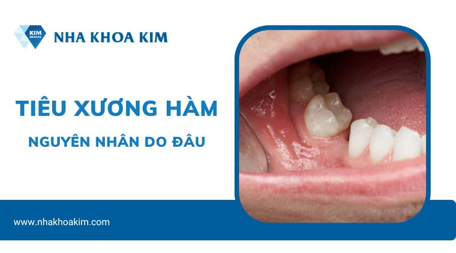 Nguyên nhân bị tiêu xương hàm