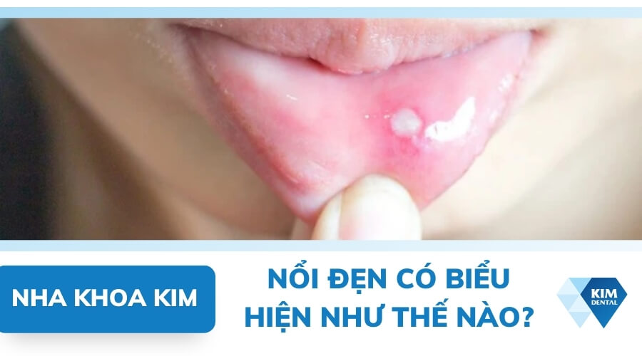 Dấu hiệu bị nổi đẹn trong miệng