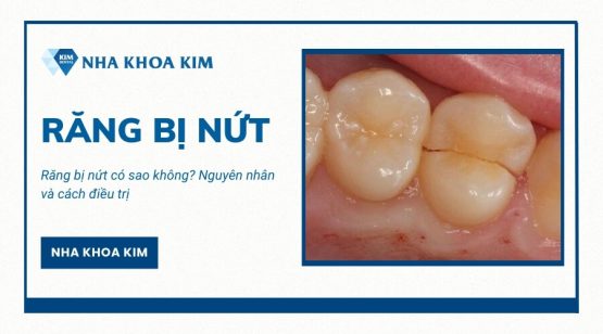 Răng bị nứt có sao không? Nguyên nhân và cách điều trị