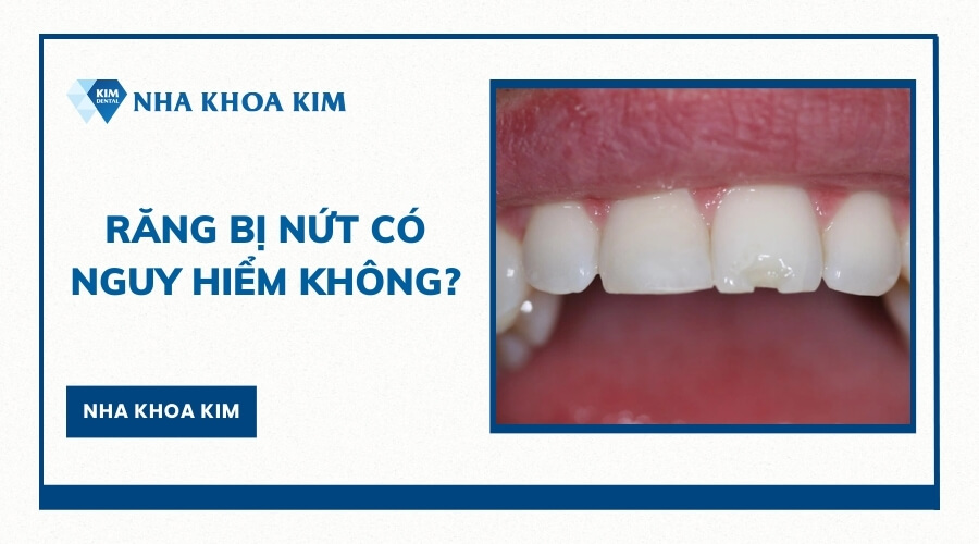 Răng bị nứt có sao không?