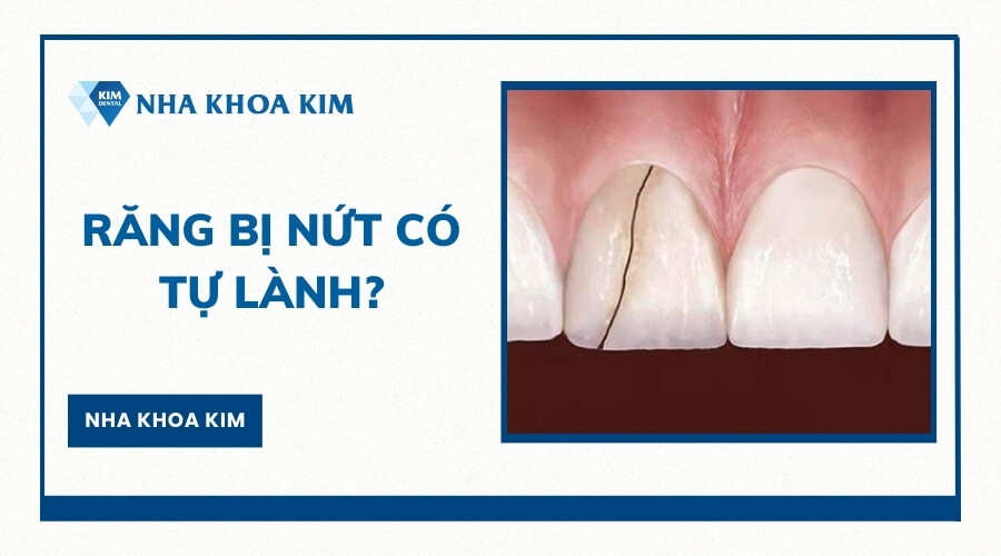 Răng bị nứt có tự lành lại không?