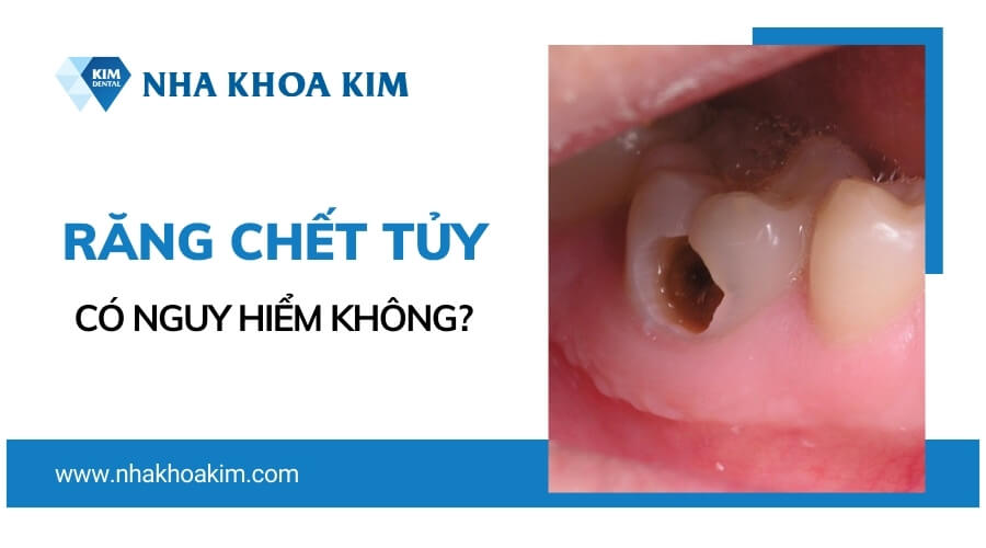 Răng bị chết tủy có nguy hiểm không?