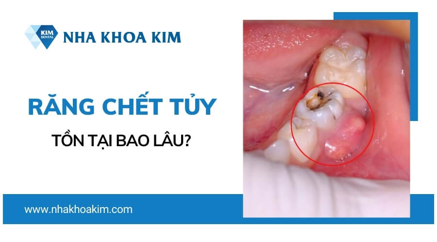 Răng chết tủy tồn tại được bao lâu?