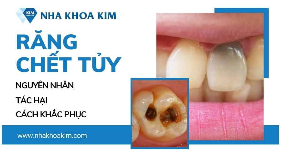 Răng chết tủy: Nguyên nhân, tác hại và cách điều trị