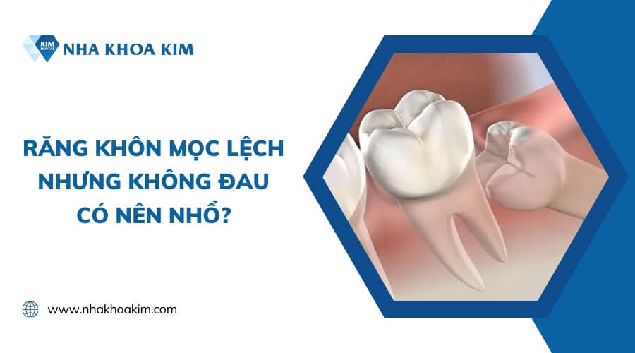 Răng khôn mọc lệch nhưng không đau có nên nhổ hay không?