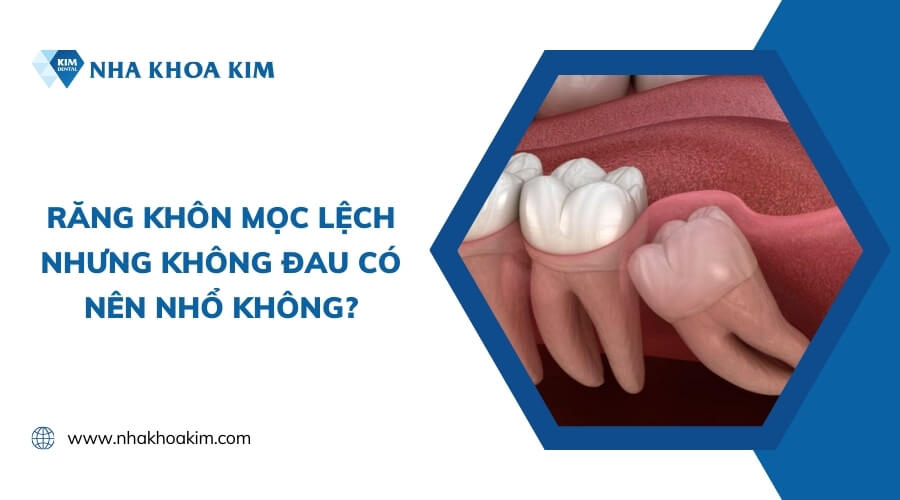 Răng khôn mọc lệch nhưng không đau có nên nhổ?