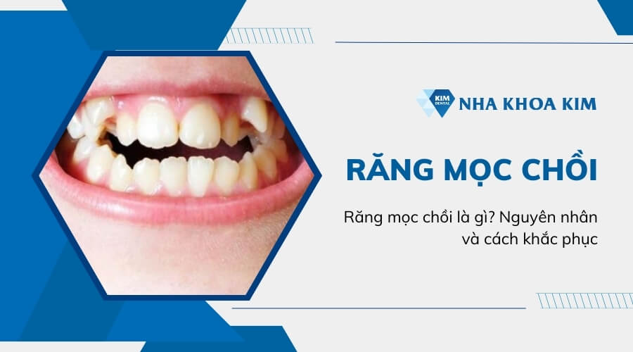 Răng mọc chồi là gì? Nguyên nhân và cách khắc phục