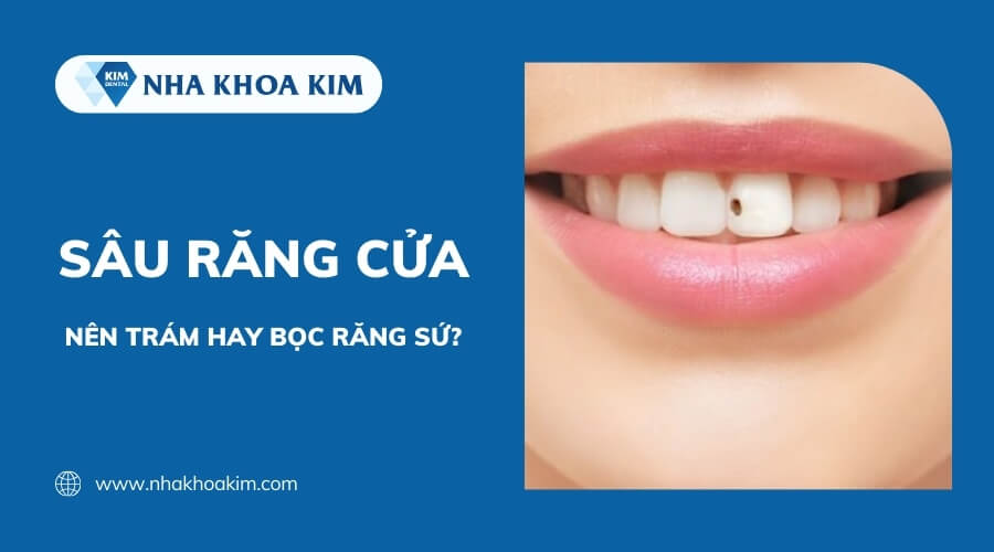 Sâu răng cửa nên trám hay bọc răng sứ?