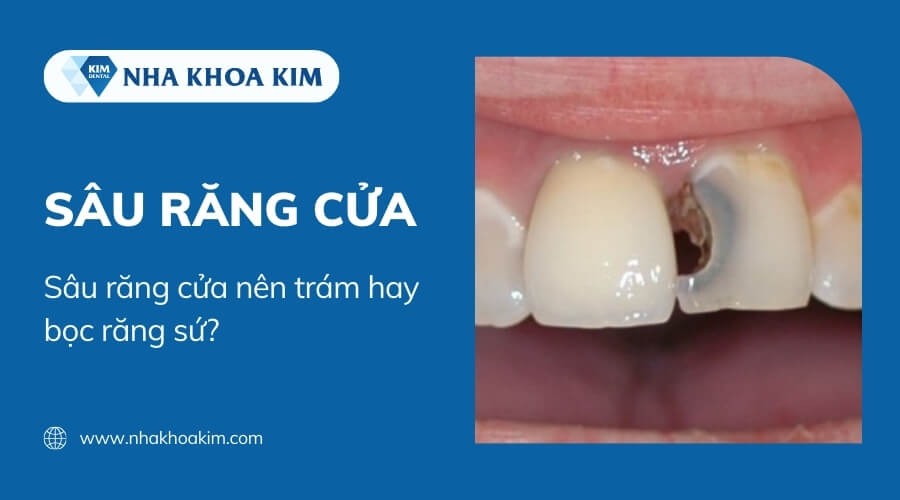 Sâu răng cửa nên trám hay bọc răng sứ?