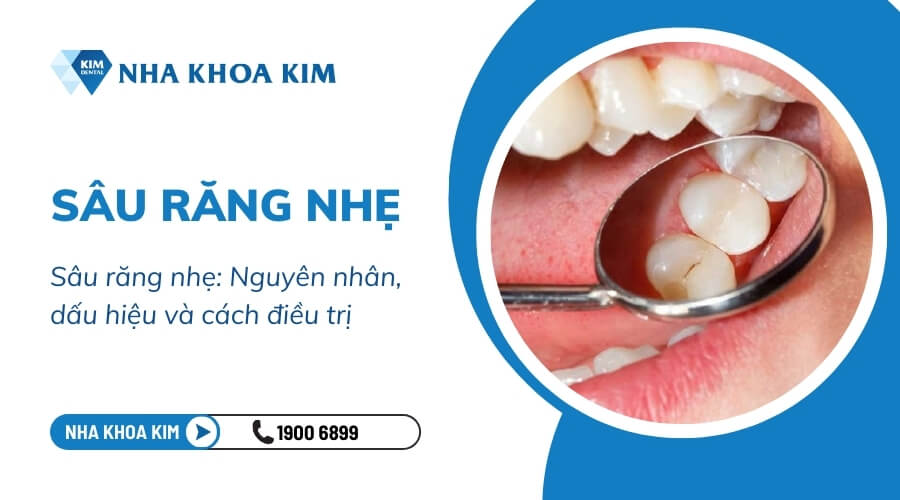 Sâu răng nhẹ: Nguyên nhân, dấu hiệu và cách điều trị