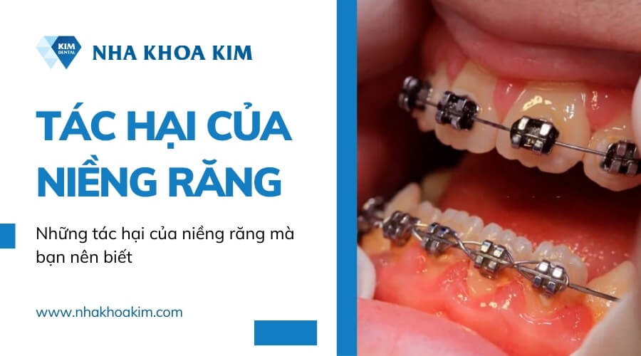 Niềng răng có tác dụng gì? 6 Lợi ích khi niềng răng