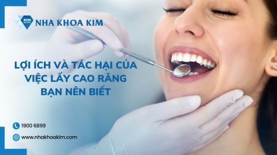 Lợi ích và tác hại của việc lấy cao răng bạn nên biết