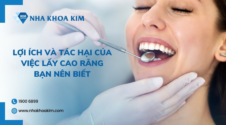 Lợi ích và tác hại của việc lấy cao răng bạn nên biết