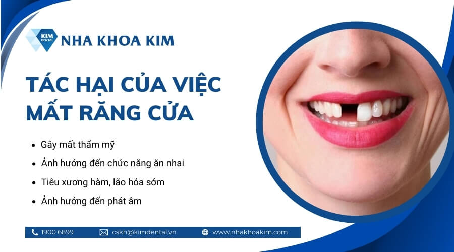 Tại sao nên trồng Implant răng cửa?