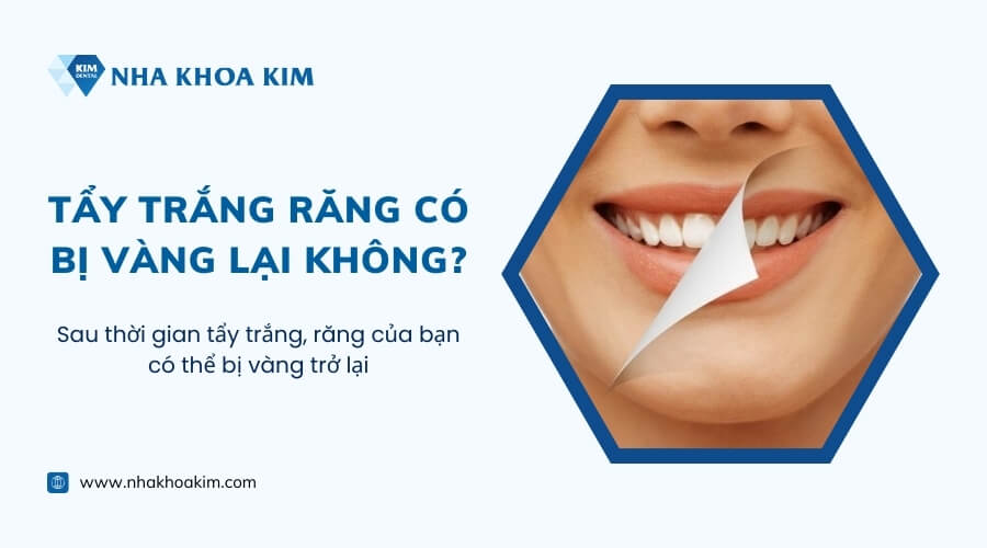 Tẩy trắng răng có bị vàng lại không? Bao lâu thì nên tẩy lại?