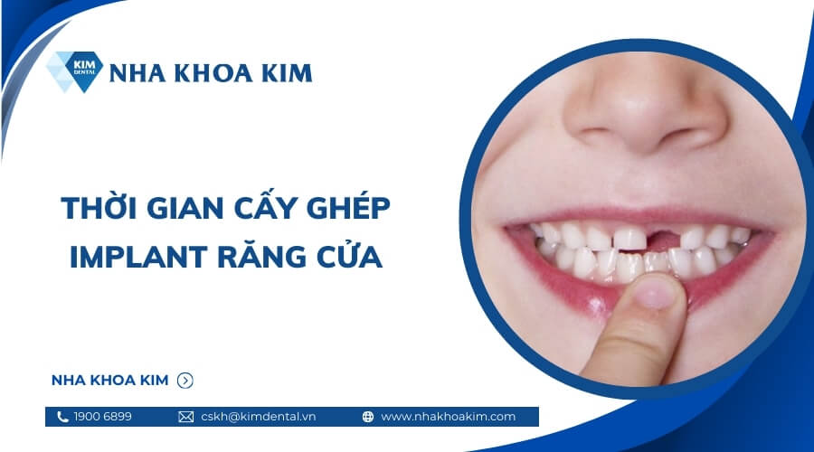 Cấy ghép Implant răng cửa mất bao lâu?