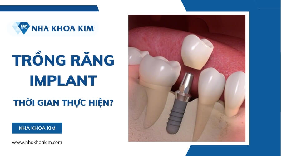 Ưu điểm khi trồng răng giả vĩnh viễn bằng Implant