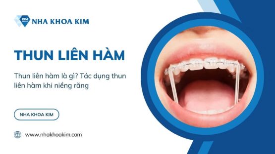 Thun liên hàm là gì? Tác dụng thun liên hàm khi niềng răng