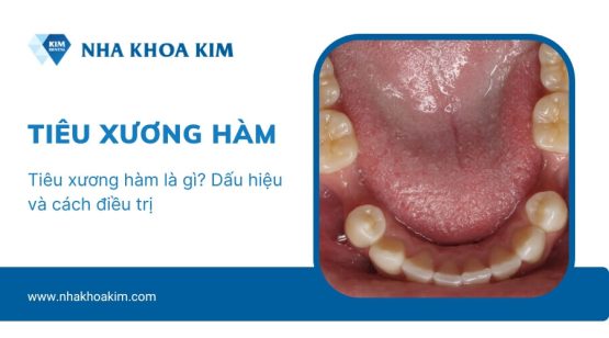 Tiêu xương hàm là gì? Dấu hiệu và cách điều trị
