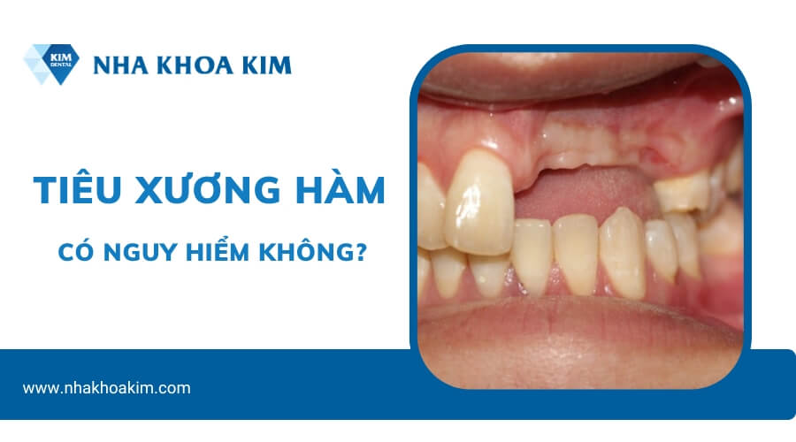 Tiêu xương hàm có nguy hiểm không?