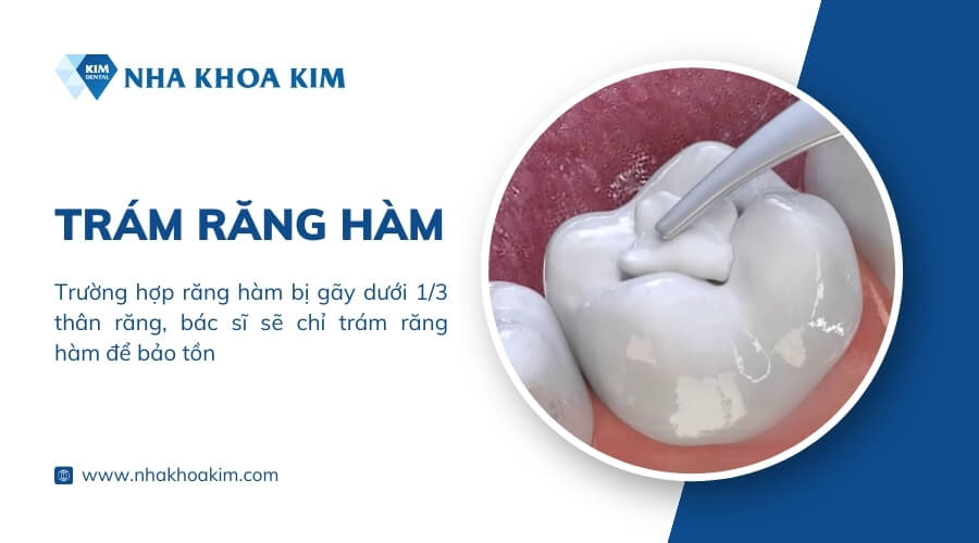 Trám răng hàm bị gãy