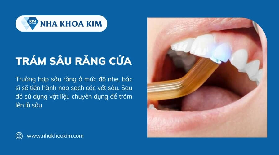 Răng cửa bị sâu có trám được không