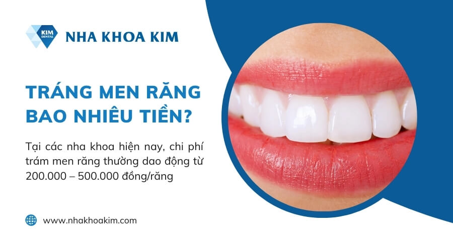 Tráng men răng bao nhiêu tiền?