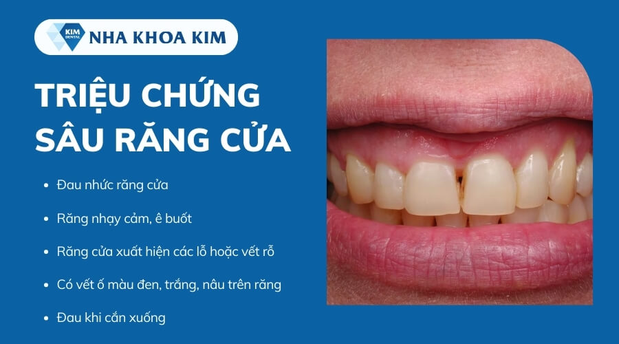 Dấu hiệu răng cửa bị sâu