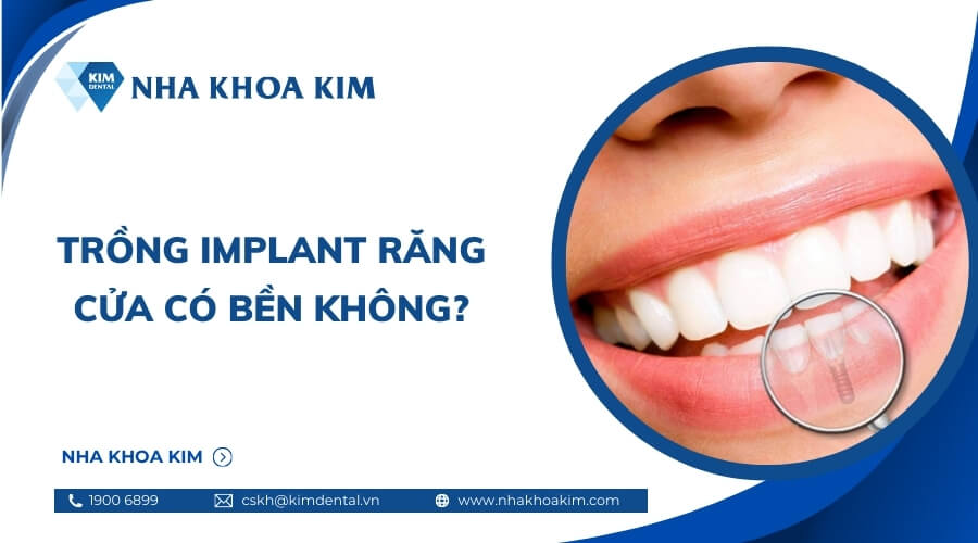 Trồng Implant răng cửa có bền không?