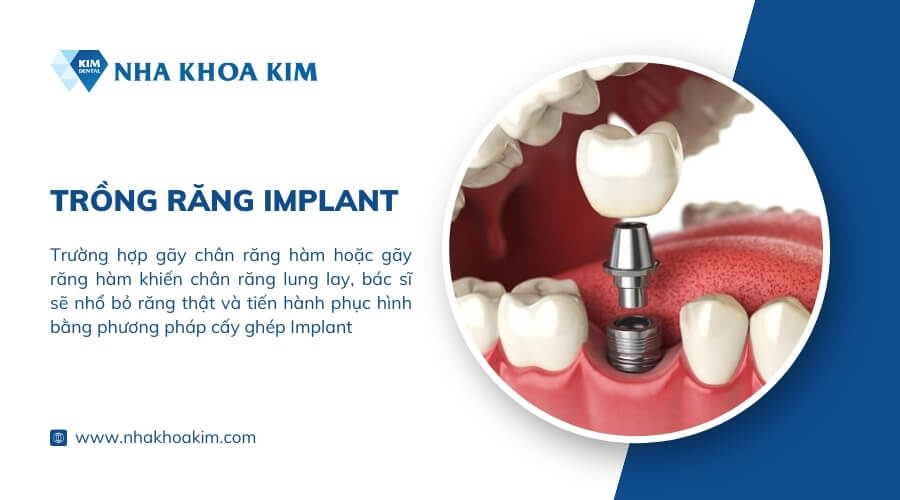 Trồng răng Implant khắc phục tình trạng mất răng hàm