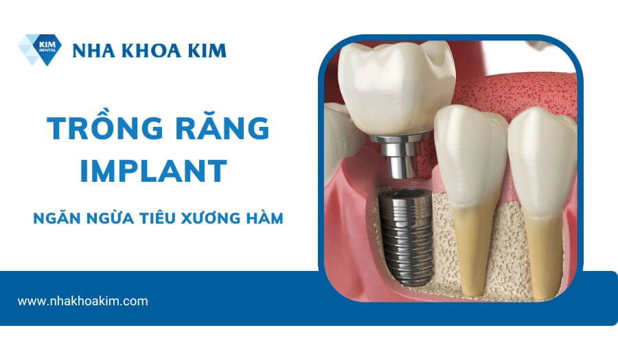 Trồng răng Implant chống tiêu xương hàm 