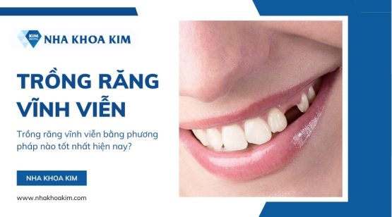 Trồng răng vĩnh viễn bằng phương pháp nào tốt nhất hiện nay?