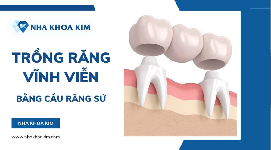 Trồng răng vĩnh viễn bằng phương pháp cầu răng sứ