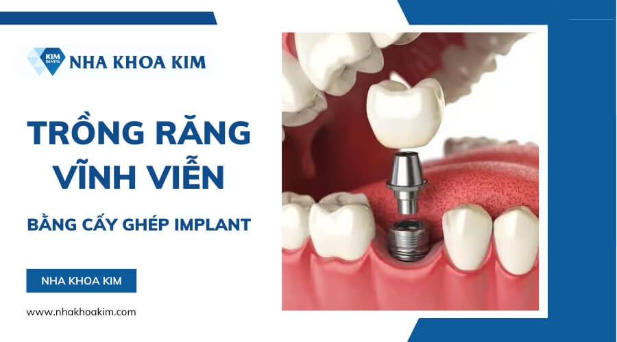 Trồng răng vĩnh viễn bằng phương pháp implant