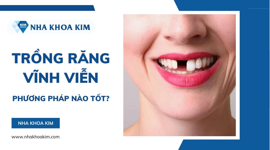 Trồng răng vĩnh viễn bằng phương pháp nào tốt?