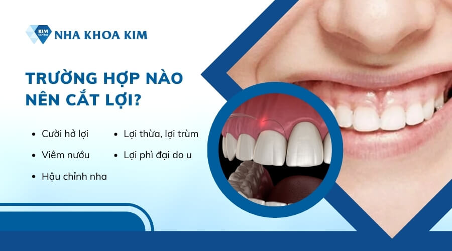 Khi nào nên cắt lợi?