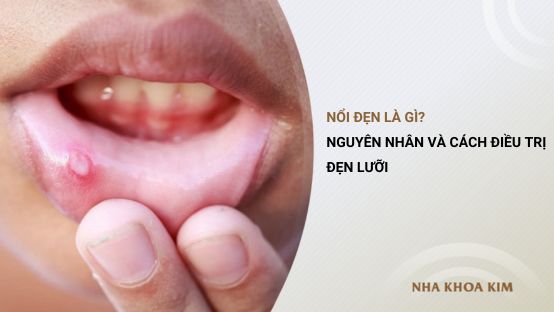 Nổi đẹn là gì? Nguyên nhân và cách điều trị đẹn lưỡi