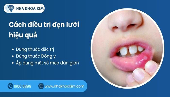 cách điều trị đẹn lưỡi
