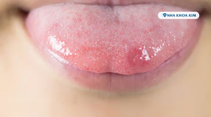 Hình ảnh lưỡi nổi hạt đỏ kèm theo loét