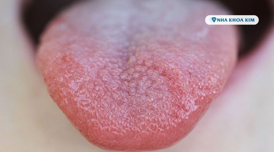 Hình ảnh đầu lưỡi nổi hạt đỏ