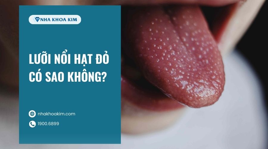 Lưỡi nổi hạt đỏ có sao không?