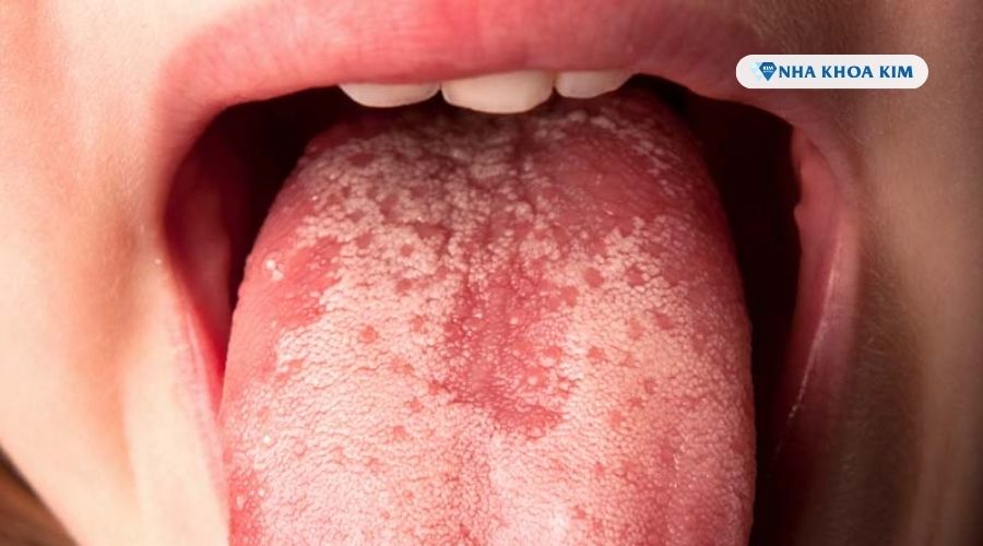 Hình ảnh lưỡi nổi hạt đỏ do nấm miệng