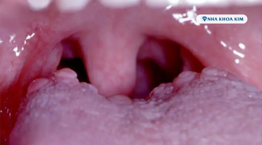 hình ảnh nổi hạt ở cuống lưỡi