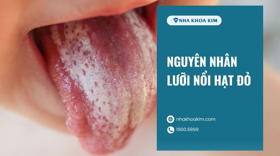Nguyên nhân gây lưỡi nổi hạt đỏ