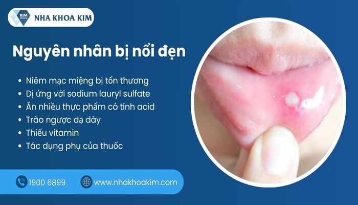 nguyên nhân bị đẹn miệng