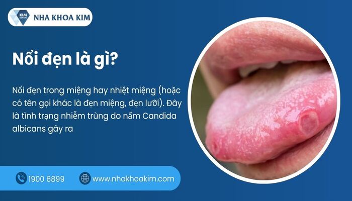 nổi đẹn trong miệng là gì