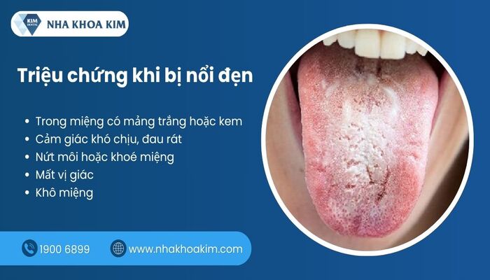 triệu chứng khi bị nổi đẹn