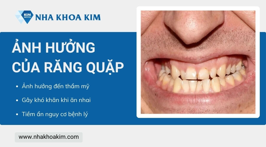 Răng quặp vào trong có sao không?