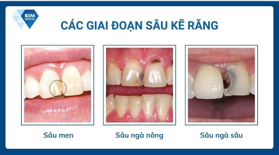 Các giai đoạn của sâu kẽ răng